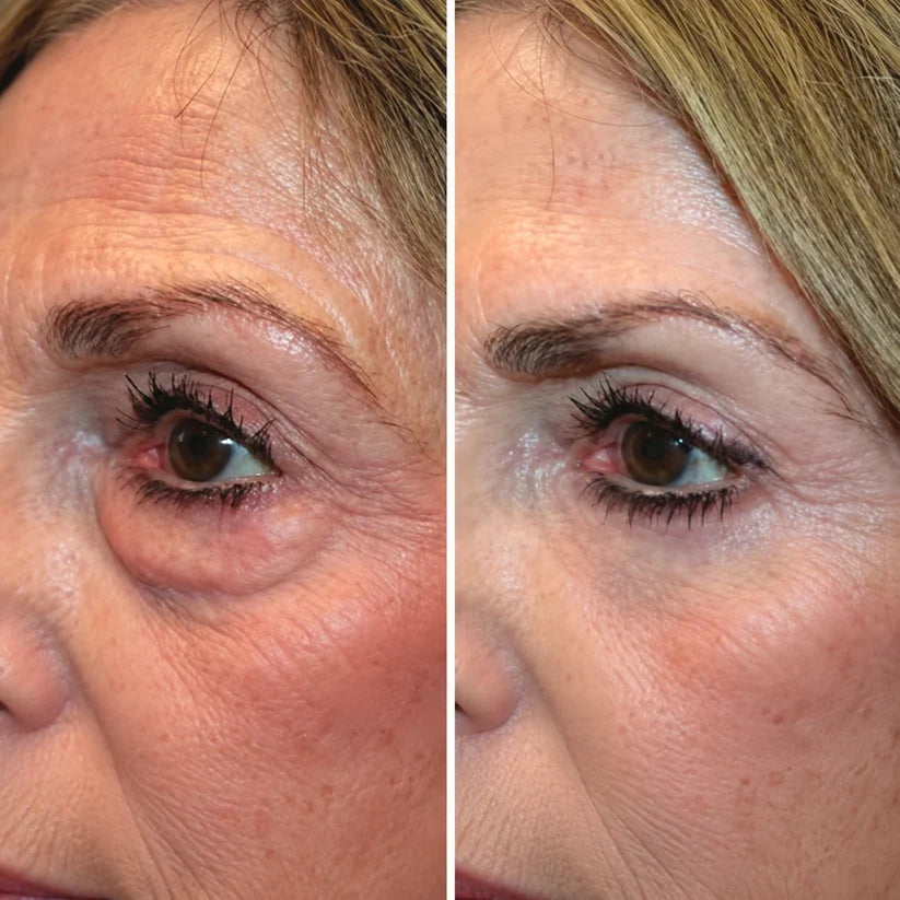 Caviraa EyeLift™ – 2-in-1 Rotlicht- & EMS-Augenpflege
